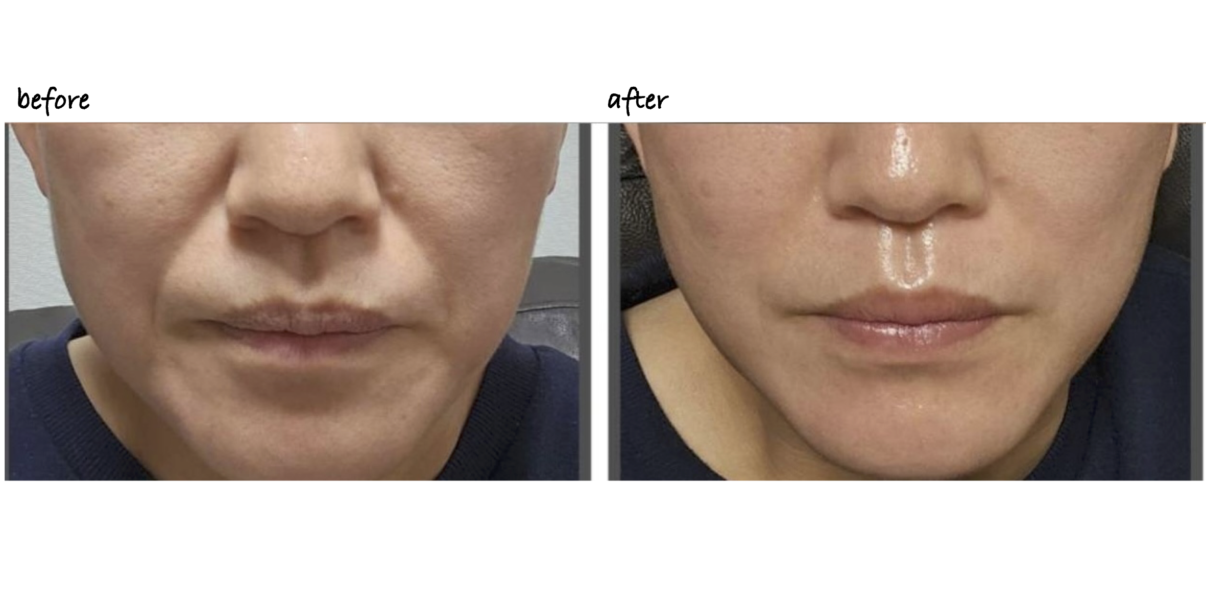 Before After 6